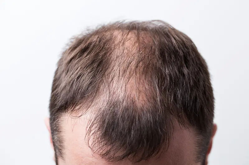 A Complete Guide to Male Hair Loss and Alopecia